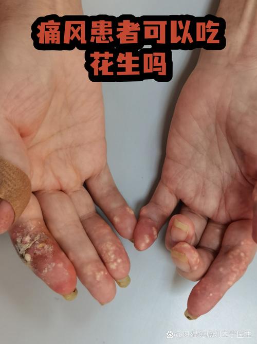 风湿为什么不能吃花生