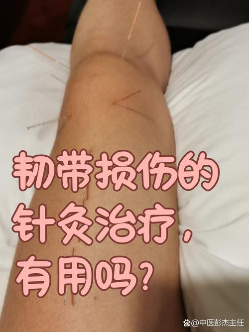 滑膜炎针灸什么穴位