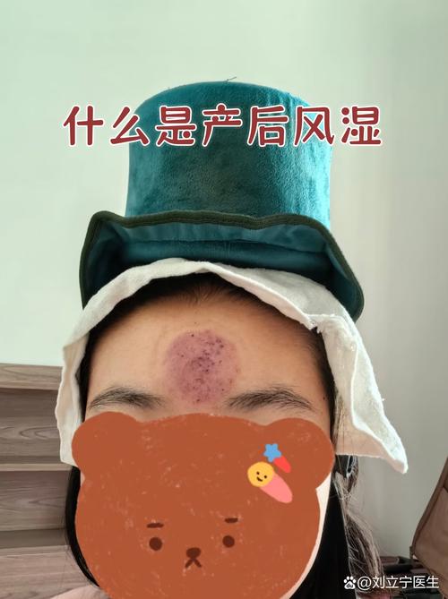 产后受凉会得类风湿吗