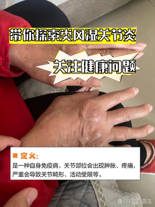 类风湿挂骨科还是外科