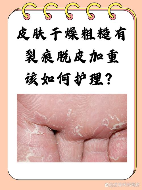 风湿硬皮病的夏天保养