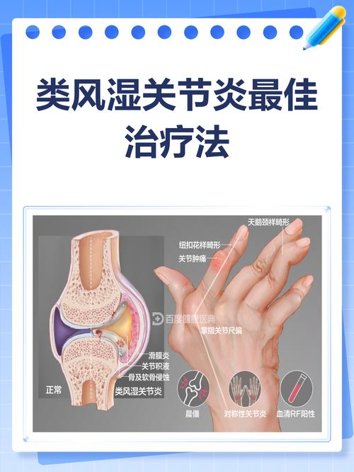 类风湿最好得治疗方法