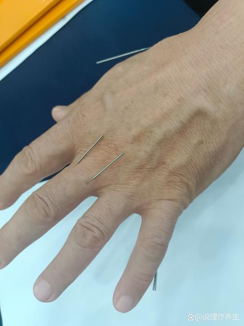 针灸治疗脑梗效果好吗