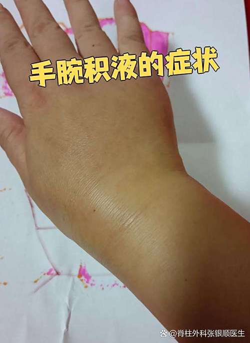 手腕疼类风湿变形图片