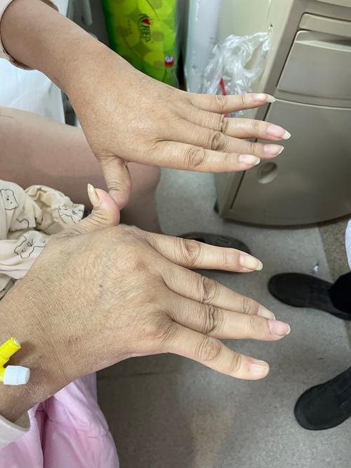 手腕疼类风湿变形图片