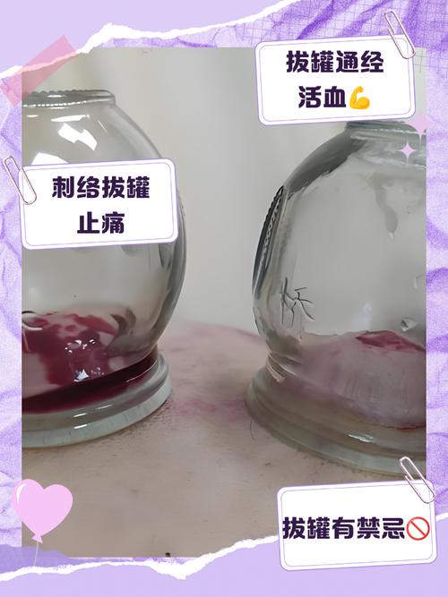 孕妇风湿可以拔火罐吗