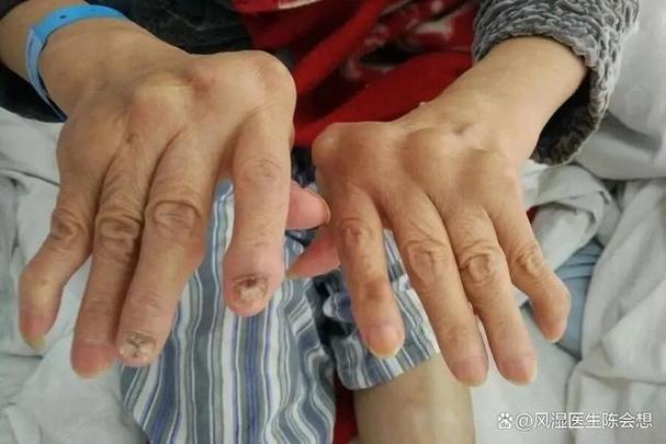风湿关节变形能治好吗