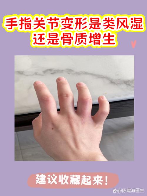 风湿关节变形能治好吗