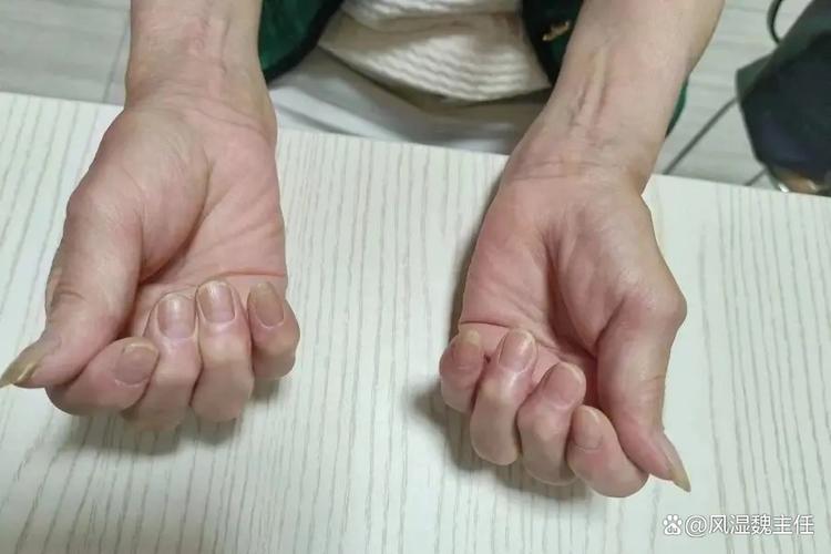 风湿关节变形能治好吗