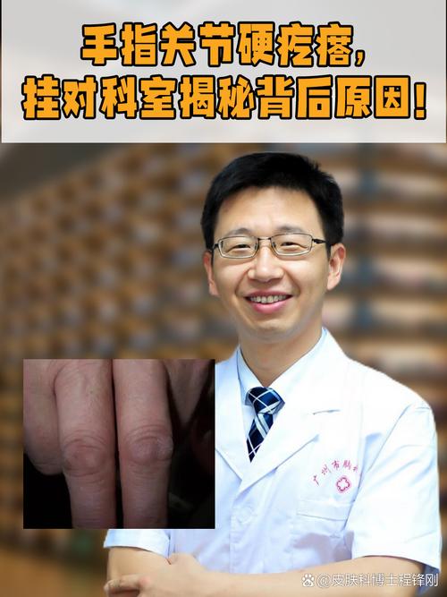 东莞类风湿哪个医生好