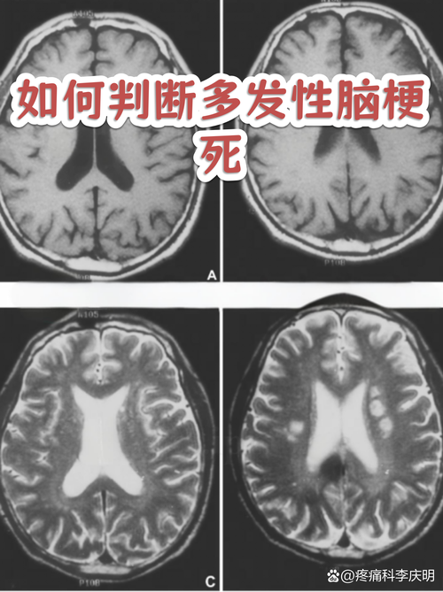 轻微多发性脑梗严重吗