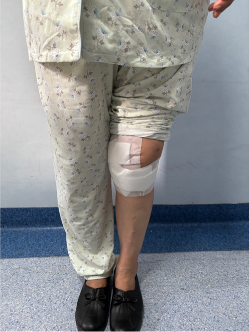 类风湿引起腿部长囊肿