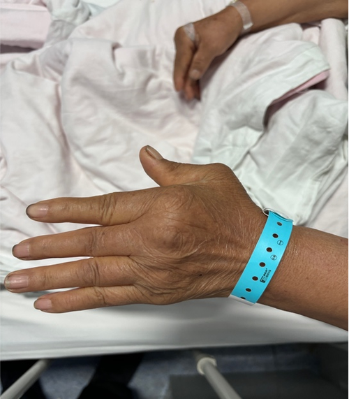 类风湿引起腿部长囊肿