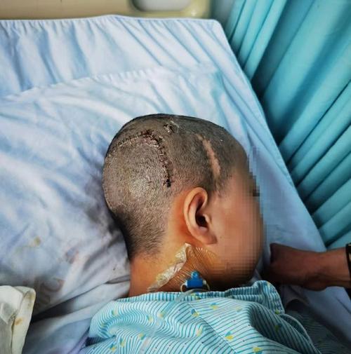 脑膜瘤手术后引起脑梗