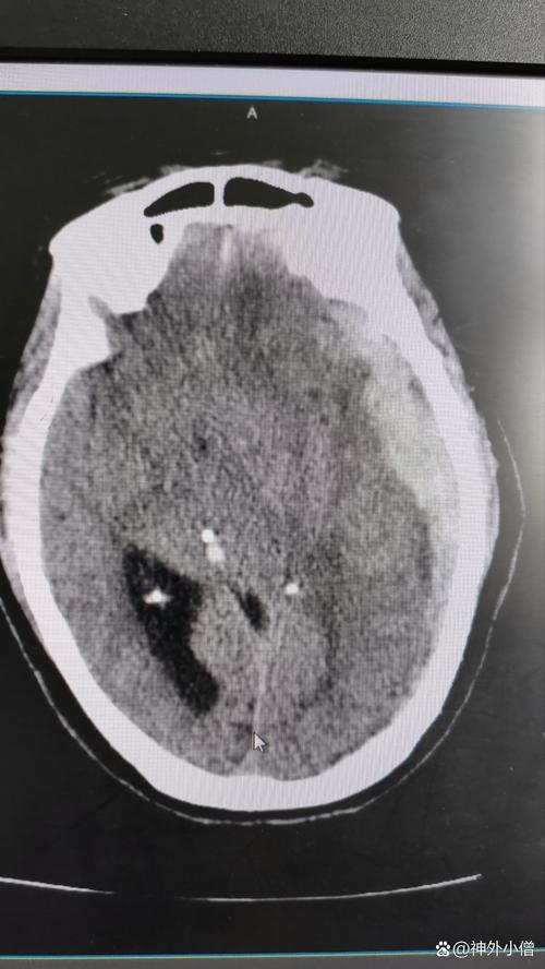 脑膜瘤手术后引起脑梗
