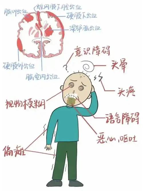 脑出血和脑梗哪个严重