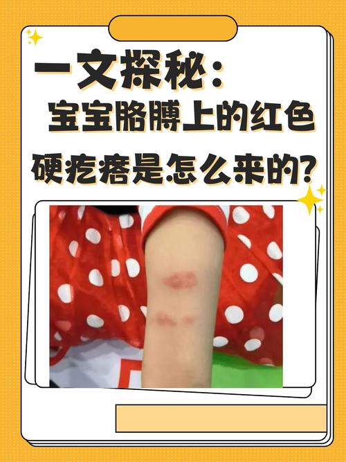 儿童风湿疙瘩怎么回事