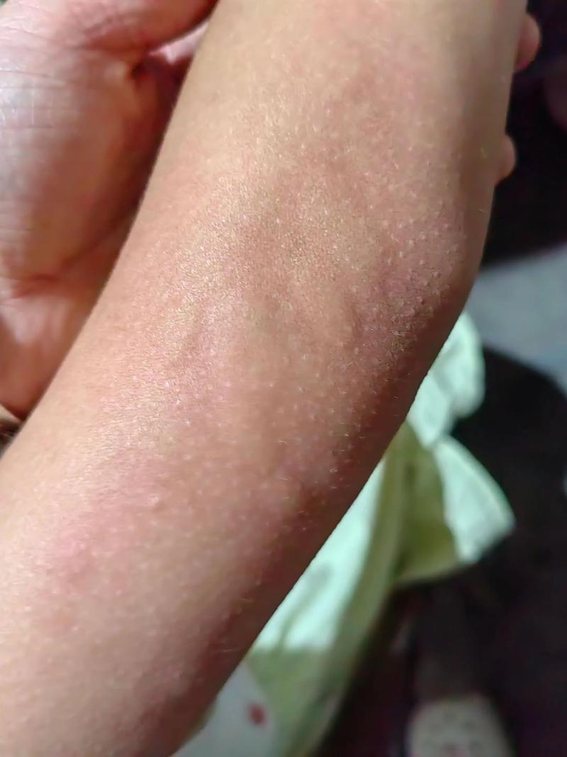 儿童风湿疙瘩怎么回事