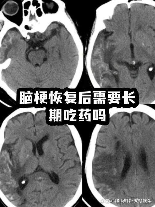 脑梗好了还继续吃药吗