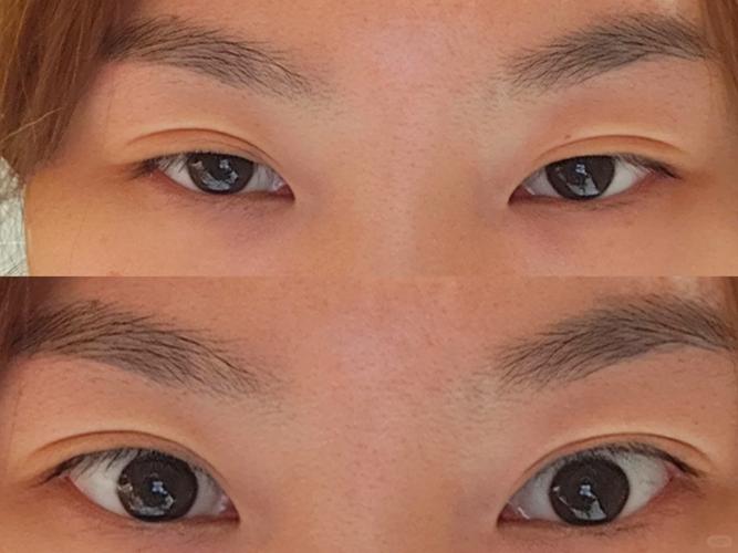 脑梗为什么眼睛睁不开