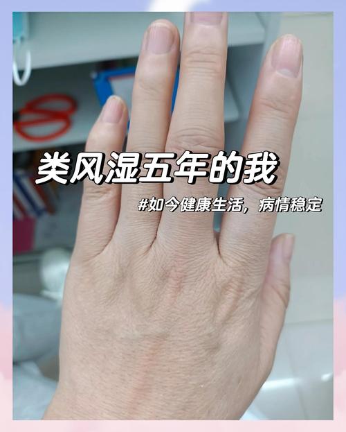 轻度类风湿可以自愈吗