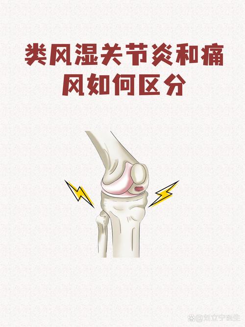 轻度类风湿可以自愈吗