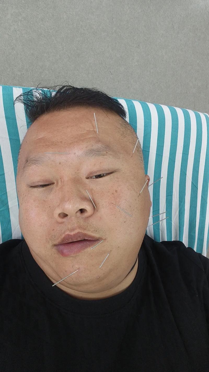 面瘫可以注射穴位针