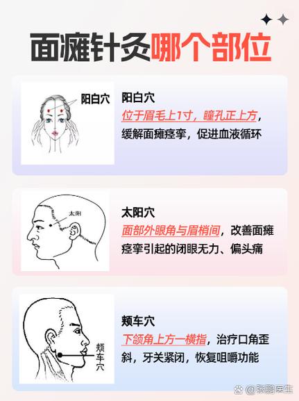 面瘫可以注射穴位针