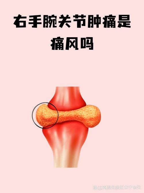 手腕疼是风湿还是痛风