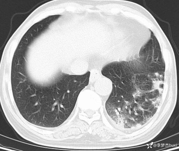 脑梗病人肺部感染症状
