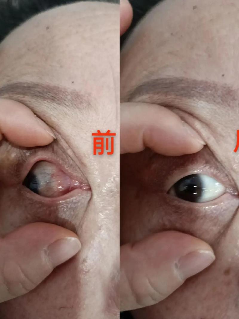 老年人眼睛充血与脑梗