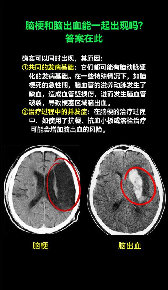 脑梗和脑出血哪个严重