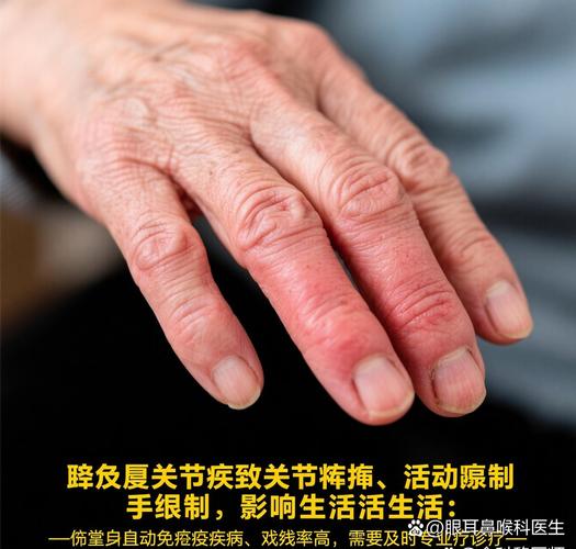 湖北内风湿医院哪家好