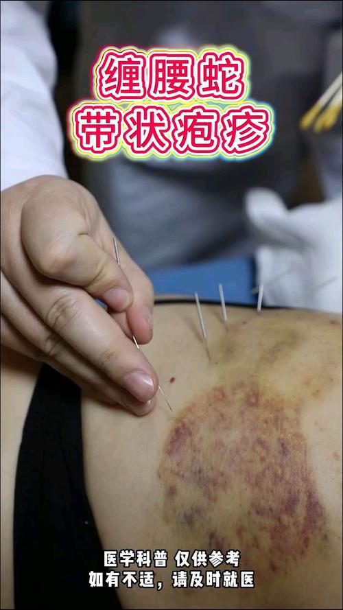 蛇胆疮针灸止痛穴位