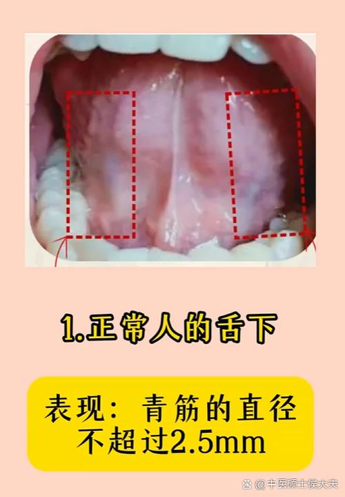如何判断脑梗的大舌头