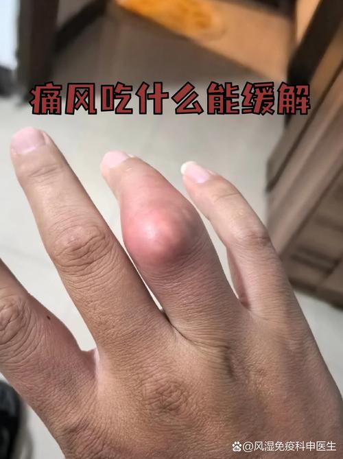 膝盖风湿可以吃鸡蛋吗