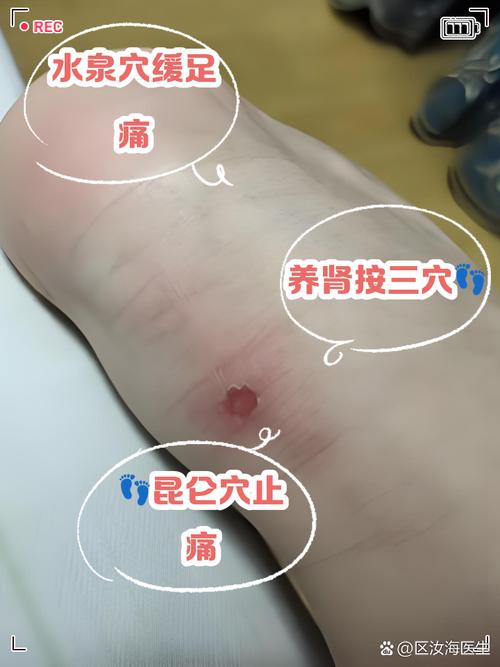 脚跟补疼痛针灸穴位