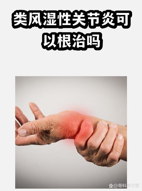 幼儿类风湿容易复发吗