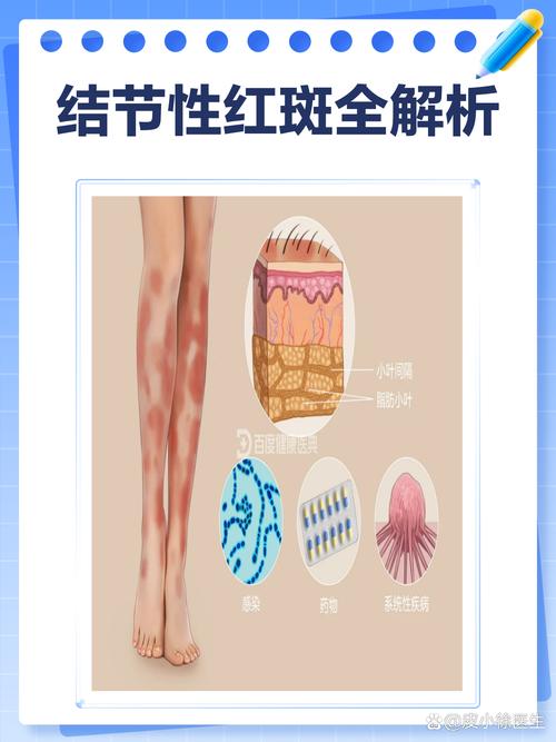 风湿结节红斑怎么治疗