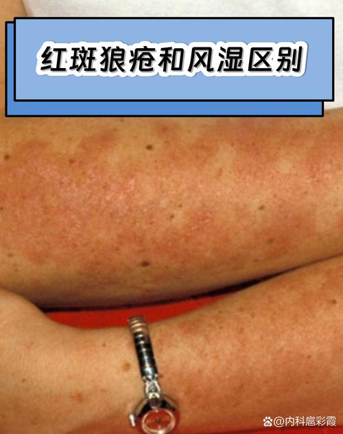 风湿结节红斑怎么治疗