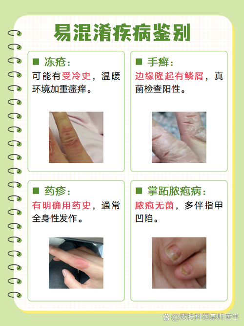 风湿关节疙瘩怎么回事