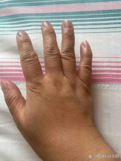 什么是类风湿初期症状