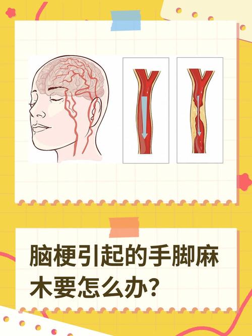 脑梗手脚麻木怎么缓解