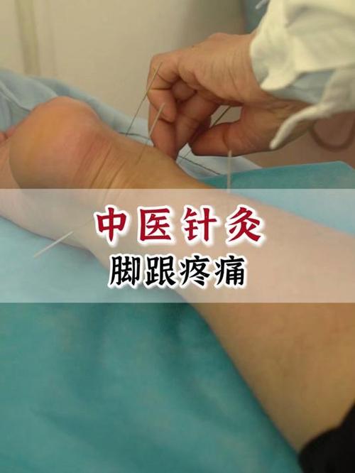 足跟痛针灸哪些穴位