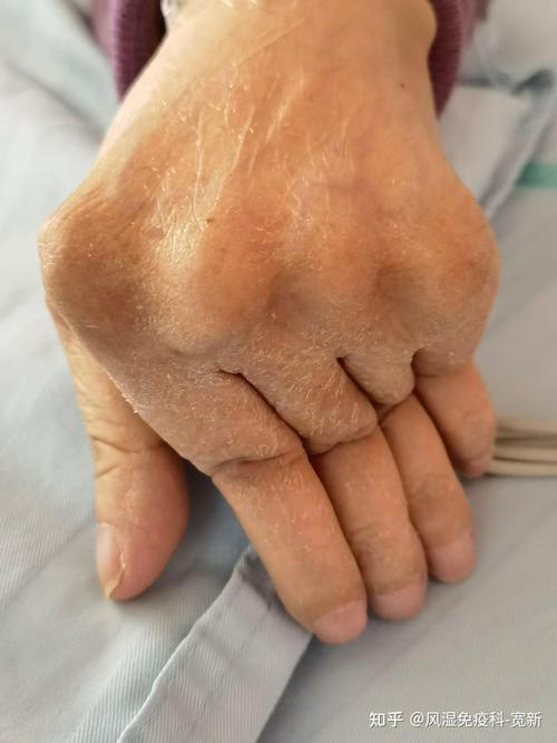 类风湿因子36正常吗