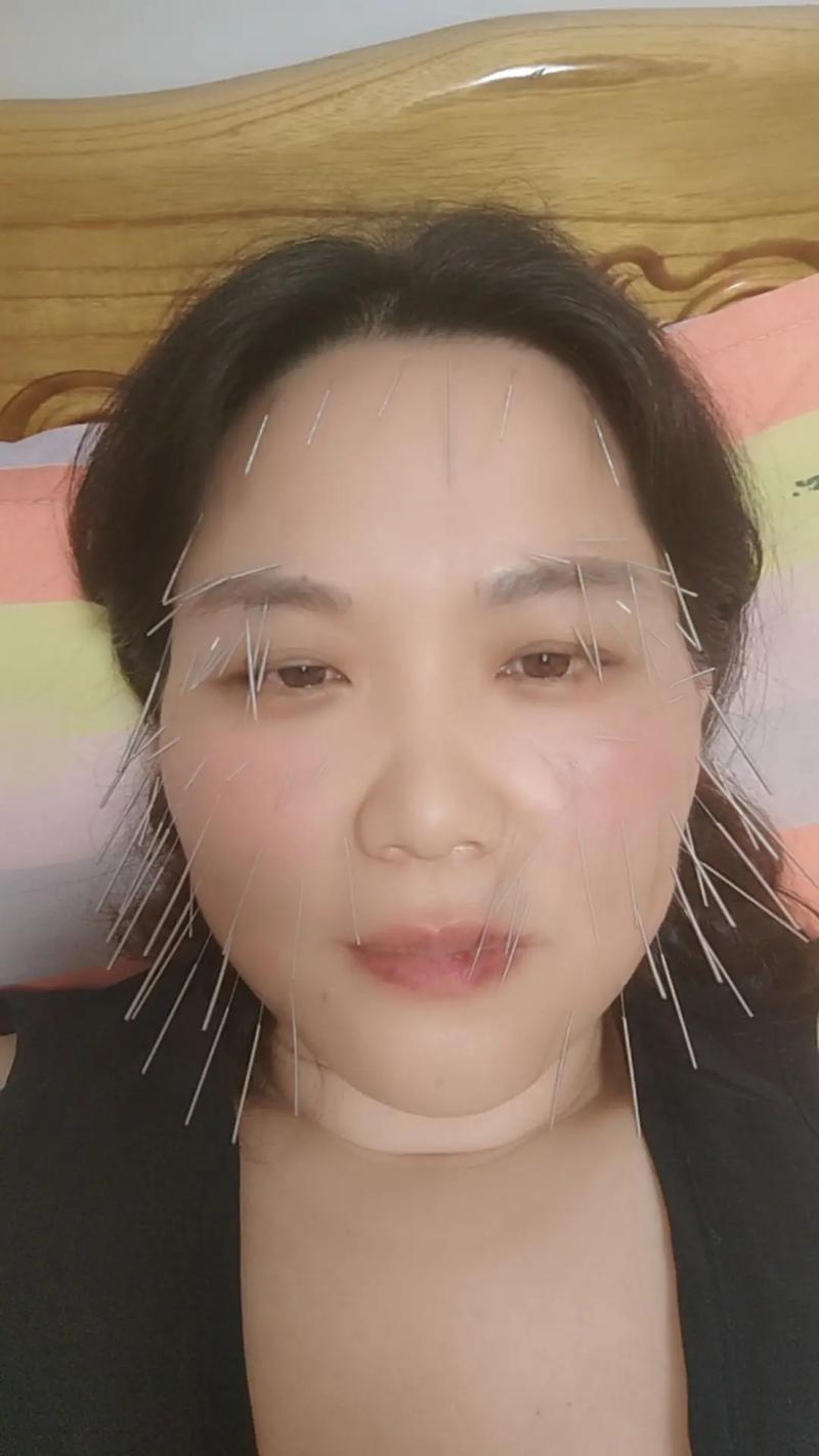 穴位针灸可以丰脸颊