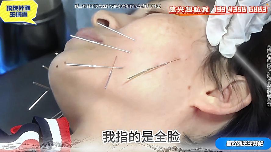 穴位针灸可以丰脸颊