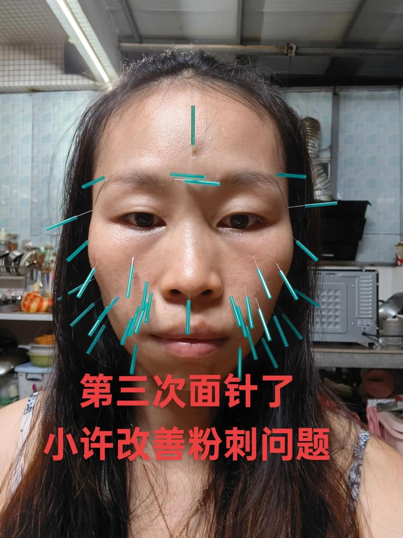 穴位针灸可以丰脸颊