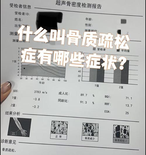 骨质疏松和风湿的症状