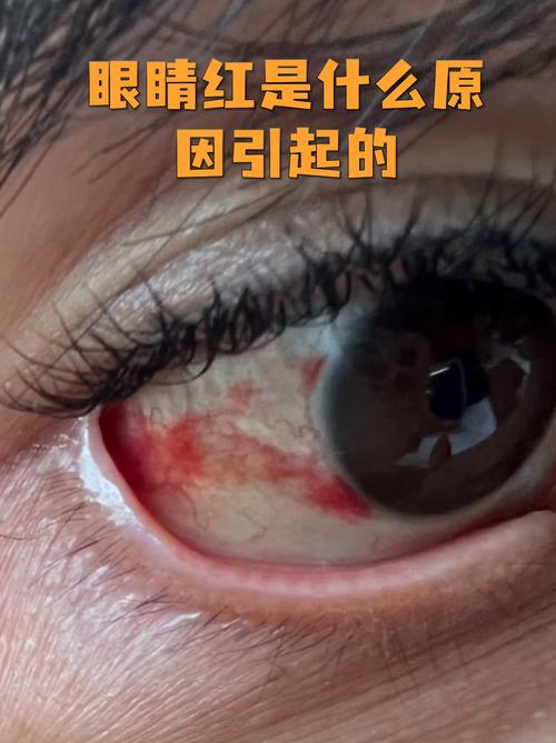 脑梗眼睛充血怎么回事